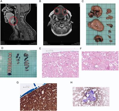 Corrigendum: Recurrent multifocal adult rhabdomyoma in an elderly woman diagnosed with Birt-Hogg-Dubé syndrome: A case report